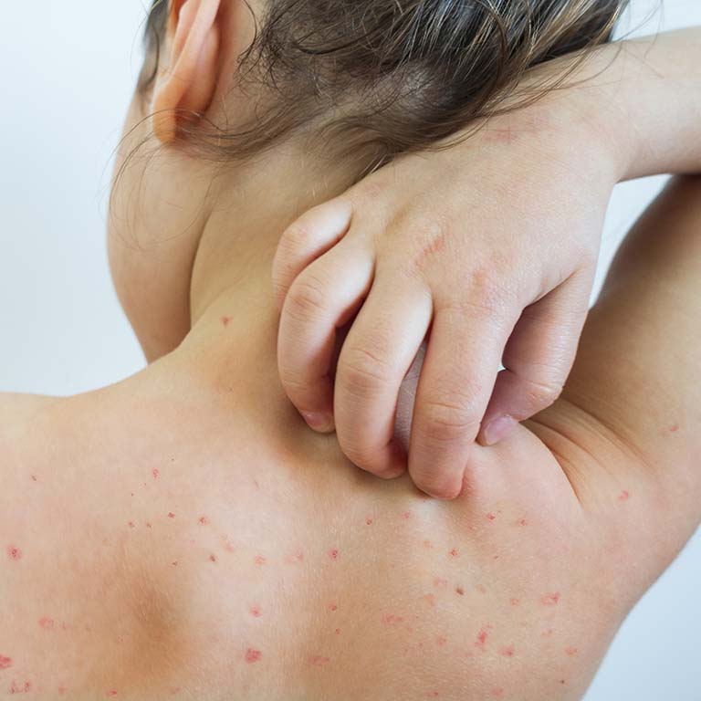A young girl with chicken pox scratches the blisters on her back.