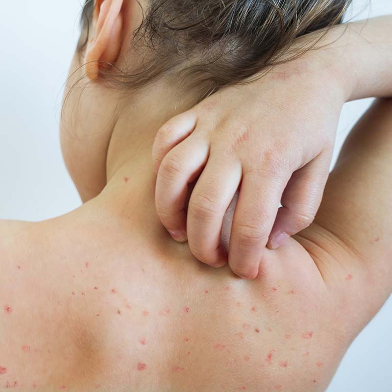 The chickenpox virus has a fascinating evolutionary history that