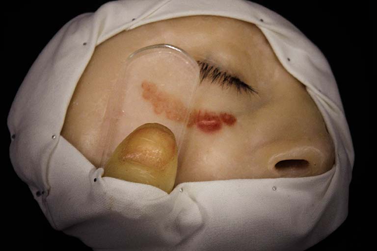Medical “moulage” (wax model of pathologies and diseases) used as a diagnostic tool for Lupus vulgaris, a turberculosis-related skin disease. It demonstrates red lesions beneath the eye that appear "apple jelly brown" when viewed under pressure through a glass slide. This is a very rare example of a moulage that includes not only the patient, but part of the hand of a doctor and an inorganic object (the glass slide).
